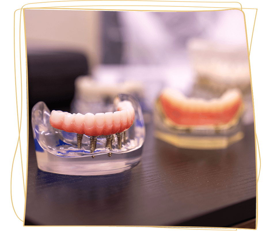 real full arch models on table