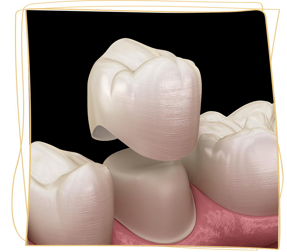 dental crowns 3d