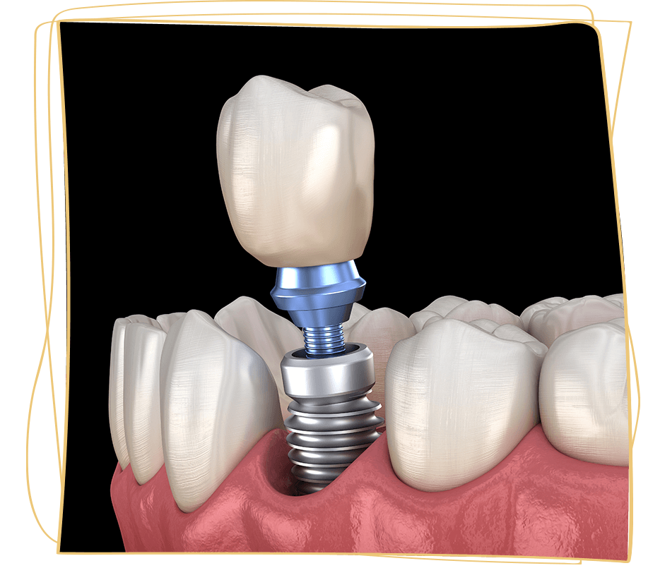 dental implant 3d