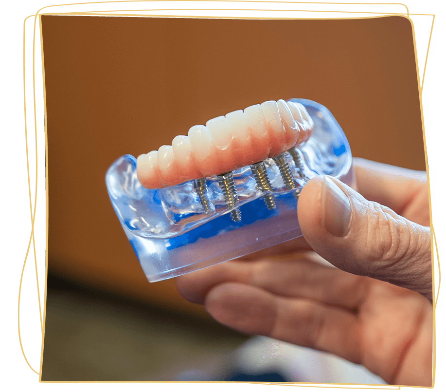 full mouth dental implants being held dr lindgren