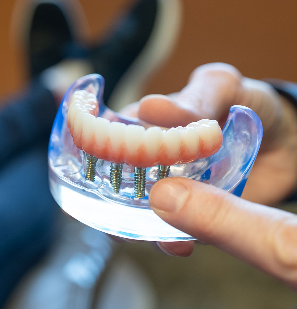 doctor points to real full arch