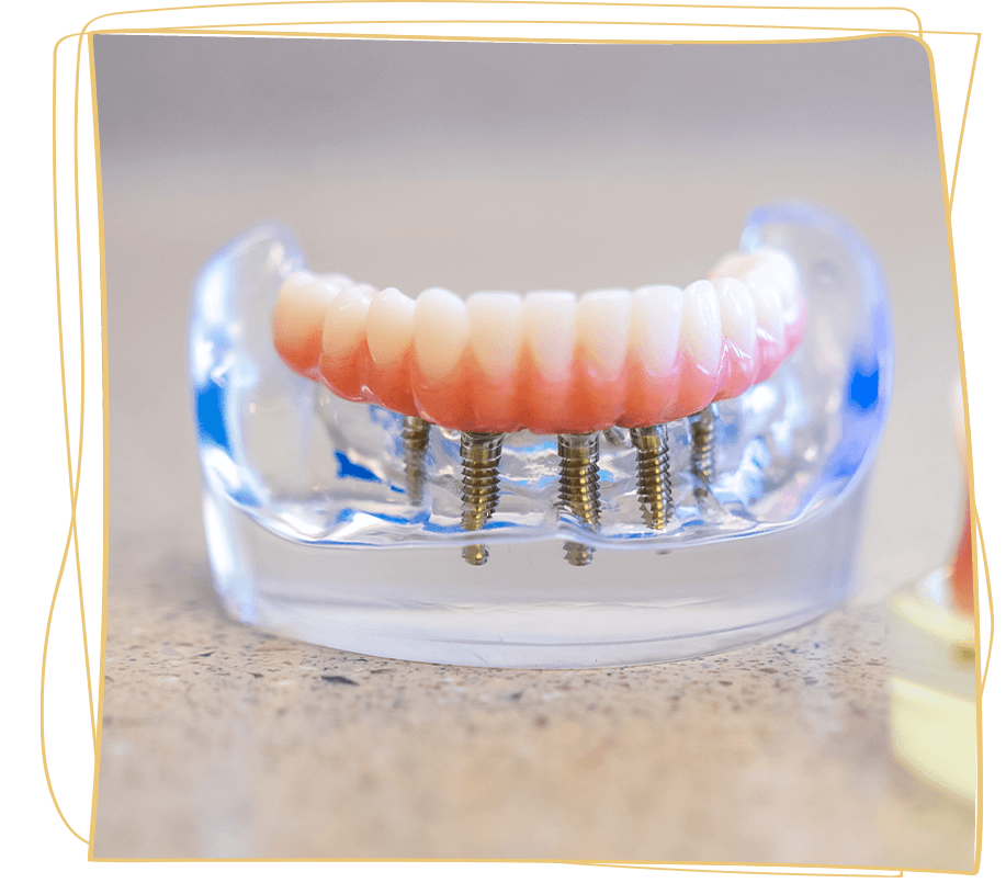 hybridge full arch real