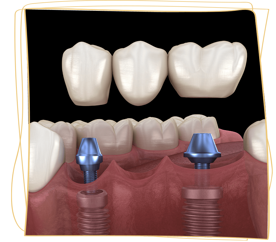implant bridge 3d