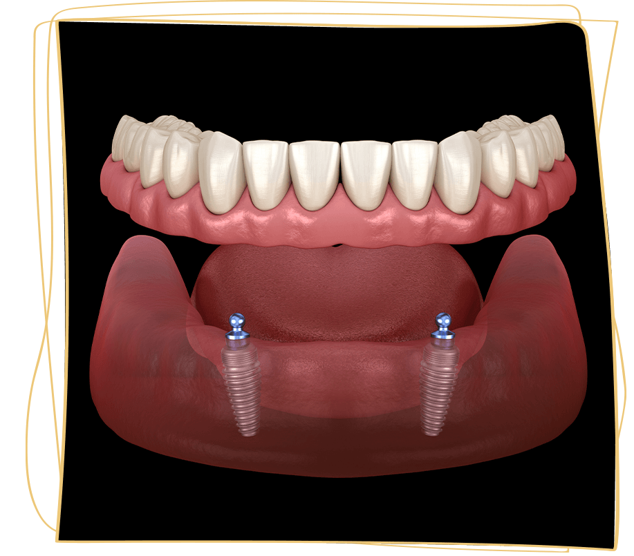 implant supported denture 3d