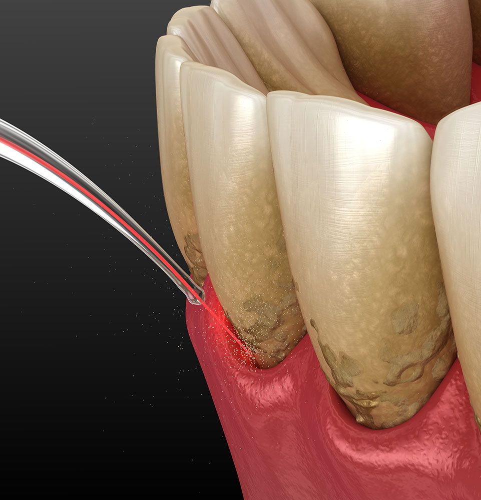 laser being used against gums