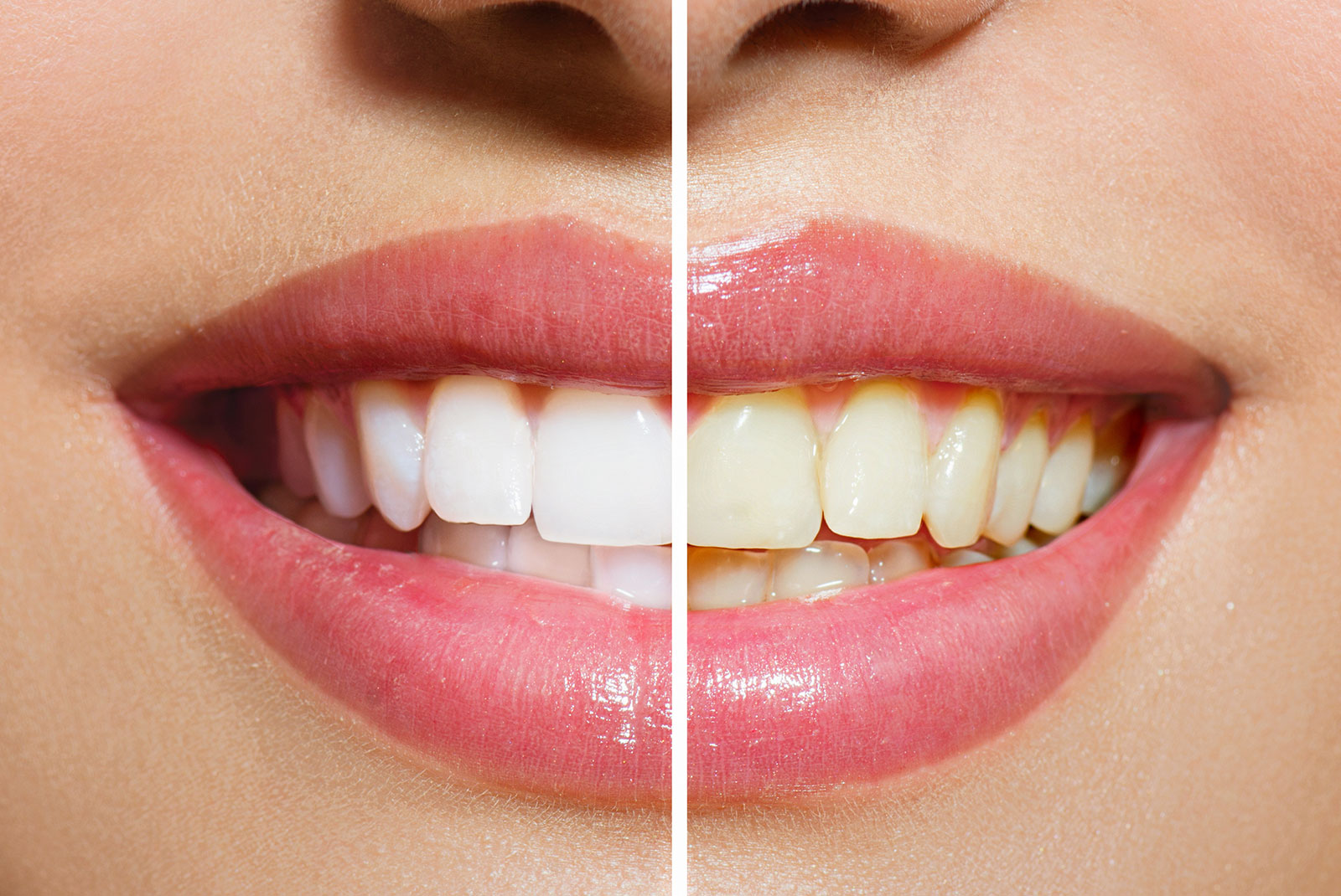 teeth whitening before and after
