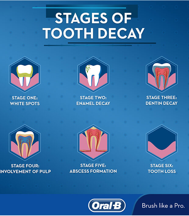 stages of totoh decay